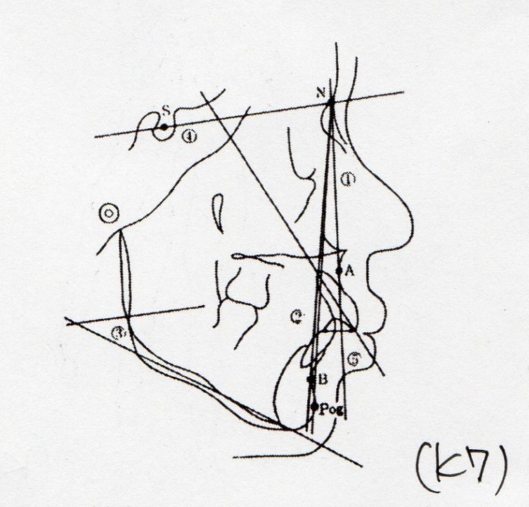 セファロ分析 角度的計測法 ノースウェスタン法（グレーバー法） きたざわ歯科 かみあわせ研究所